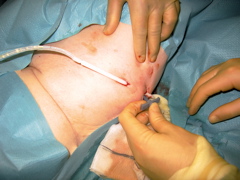 indwelling pleural catheter